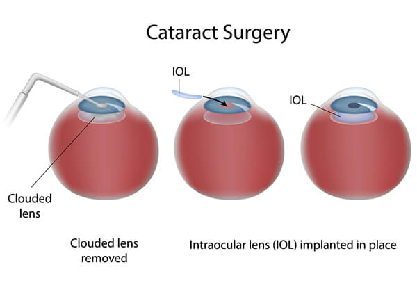 Cataract Surgery. Three eye balls in a row. The first eye has a clouded lens. The second and third each show the Intraocular lens (IOL) implanted in place.